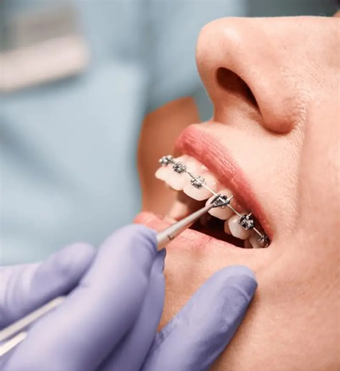 Orthodontic Treatment